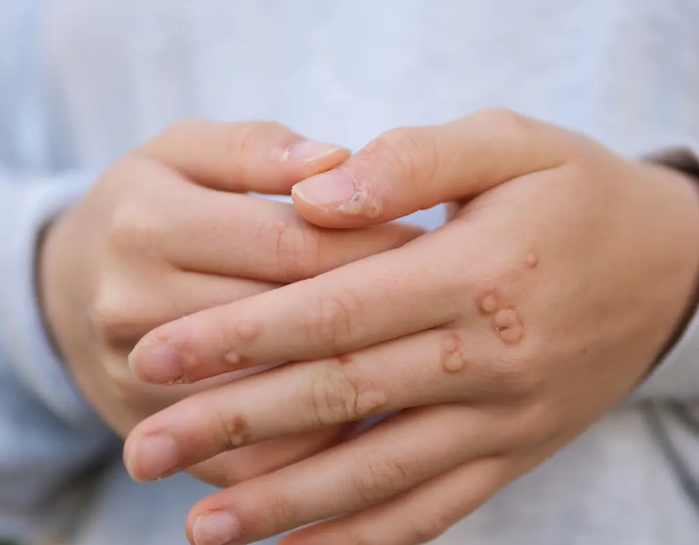 Augenoberlider nach einer Lidstraffung in der Dermatologie Friedensengel